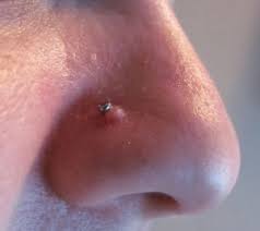 Hypertrophic Scar That Formed Around a Nostril Piercing