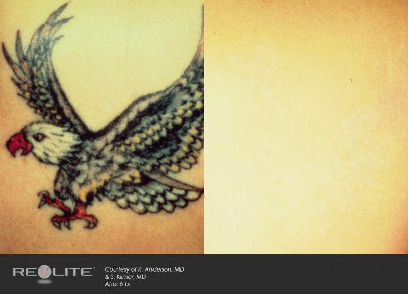 Laser Tattoo Removal Before and After