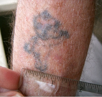 Faded Tattoo Being Measured for Laser Tattoo Removal