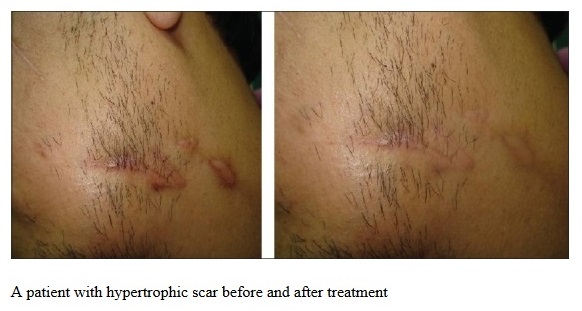 Hypertrophic Scars Respond Well to Silicone Gel Scar Therapy Treatments