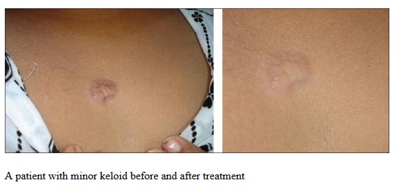 Minor Keloid Scars Respond Well to Silicone Gel Scar Therapy Treatments
