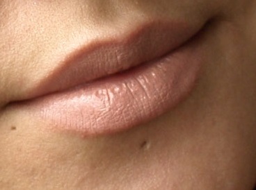 Example of an Atrophic Piercing Scar 