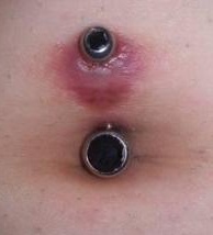 Belly Button Piercing Hypergranulation