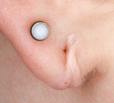 Hypertrophic Scar Around a Torn Earlobe Piercing Hypertrophic Scar Around a Torn Earlobe Piercing