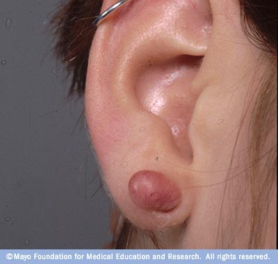 Ear Piercing Keloid Scar Picture From the Mayo Clinic
