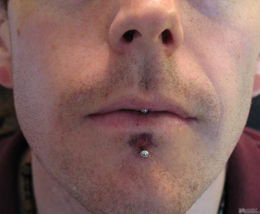 Bruised Lip Piercing Caused by Tight Jewelry 