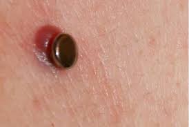 Piercing Hypergranulation Issue 