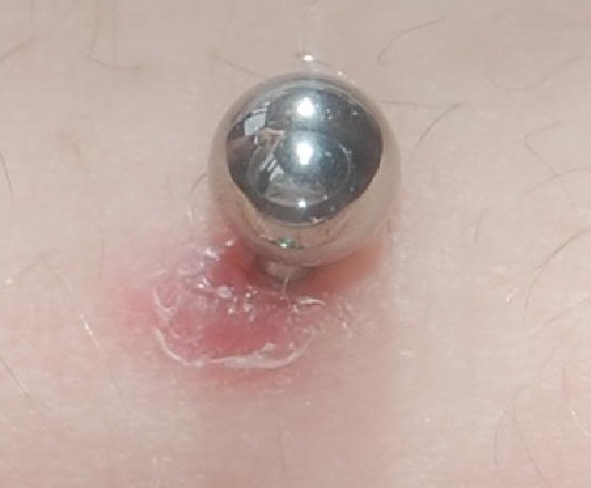 Lymph Around a Healing Piercing | Piercing Crusties 