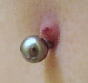 Example of a Piercing Hypergranulation Issue 