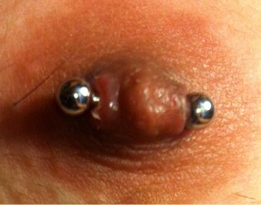 Hypertrophic Scar, Scarring, Piercing Scars, Body Jewelry
