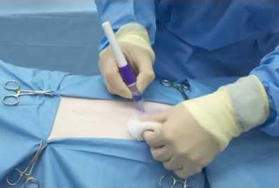 DermaBond Can Be Used to Fill Scarification Designs for More Pronounced Hypertrophic Scars 