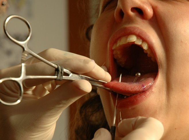 Double Tongue Piercing Procedure in Progress 