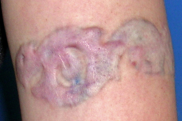 Hypertrophic Scarring Over a Tattoo 