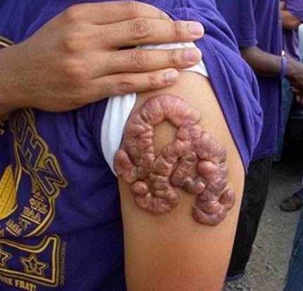 Keloid Scars Can Destroy a Scarification Piece 