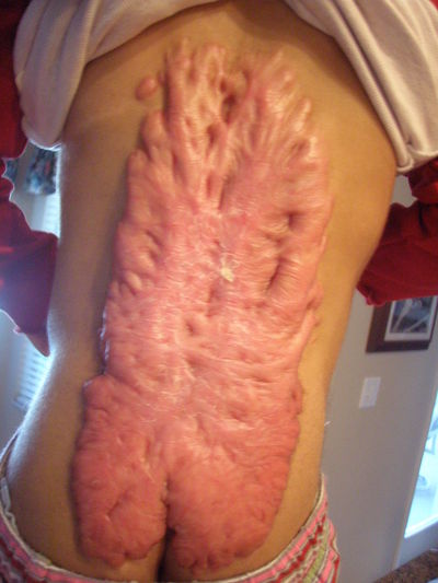 Keloid Scarring Over a Full Back Tattoo 