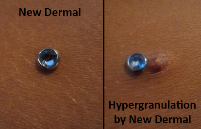 Before and After Photos Showing How a Hypergranulation Formed by a New Dermal Piercing 