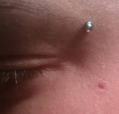 Minor Facial Atrophic Scar From Dermal Piercing Removal 
