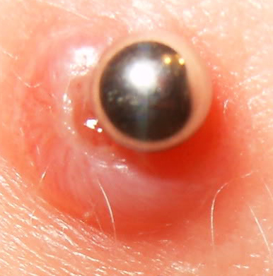 Hypergranulation Ring Around an Irritated Dermal Piercing 