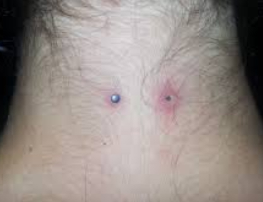 Dermal Piercing Hypergranulation Scar 