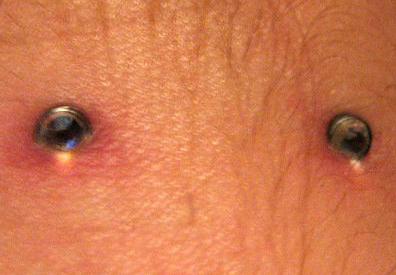 Dermal Piercings Swallowed by the Fistulas (Photo Complements of Piercingtime.com) 