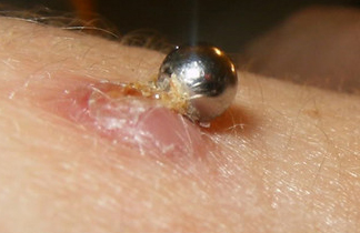 Infected Piercings | Piercing Infections 