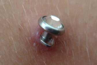 Photo of a Rejecting Dermal Piercing, From the Piercing Bible Website 