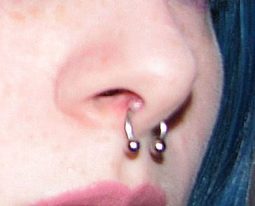 Septum Piercing Hypergranulations Are Sometimes Mistaken for Keloids 
