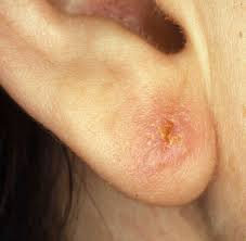 Ear Piercing Infection | Infected Ear Piercing 