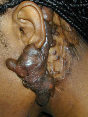 Significant Keloid Scarring Around an Ear Piercing 