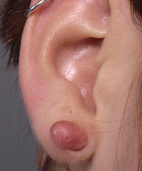 Picture of a Keloid Scar 
