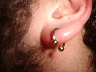 Swollen Earlobe Piercing 