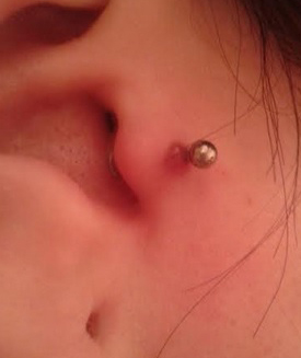 Ear Piercing Hypergranulation | Ear Piercing Bump 