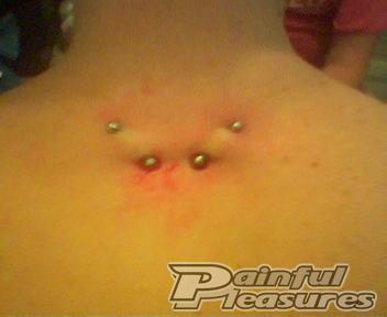 Swollen Surface Piercings | Surface Piercing Pictures on PainfulPleasures.com Swollen Surface Piercings | Surface Piercing Pictures on PainfulPleasures.com