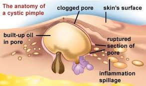 pimple diagram, tattoo pimples, what is a pimple