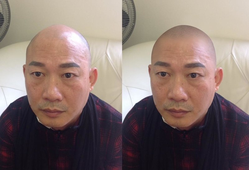 scalp micropigmentation, hair loss, tattoo