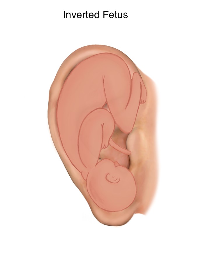 Inverted Fetus, Paul Nogier Diagram, Ear Diagram