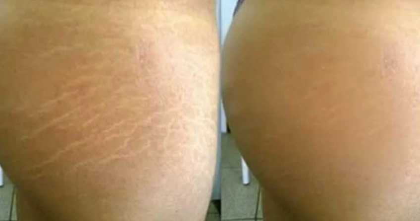 stretch marks, tattoo cover up, stretch mark tattoo