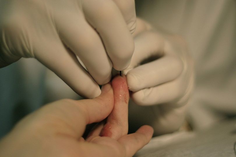 implanting magnet, body modification, cyborg, biohack, finger magnet implant