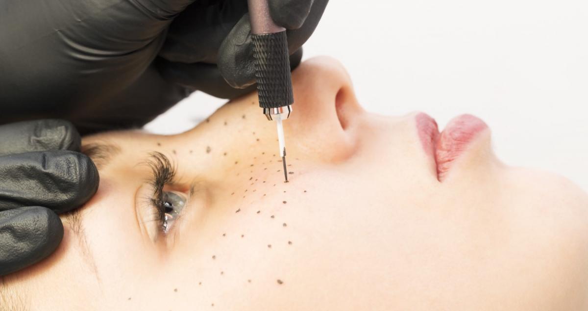 Woman getting faux freckle tattoos by stick and poke method