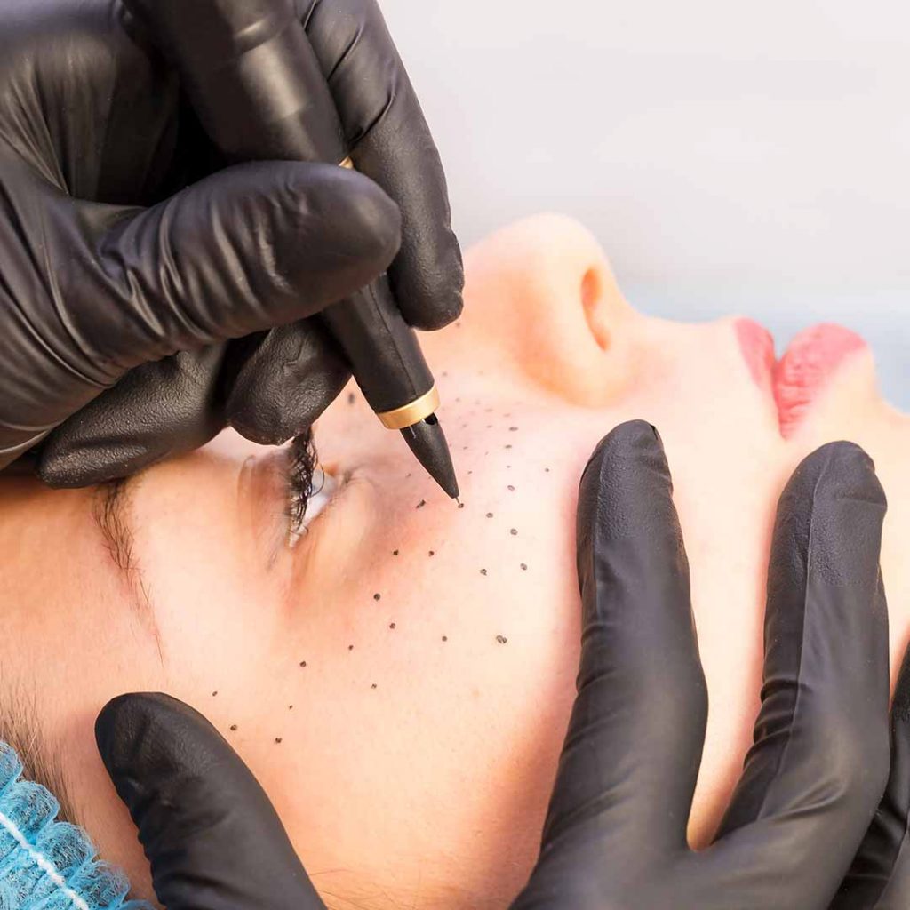 Client getting PMU faux freckle procedure done