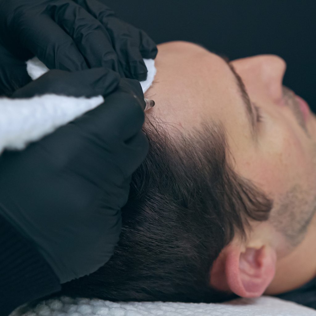 Client receiving PMU scalp micropigmentation procedures
